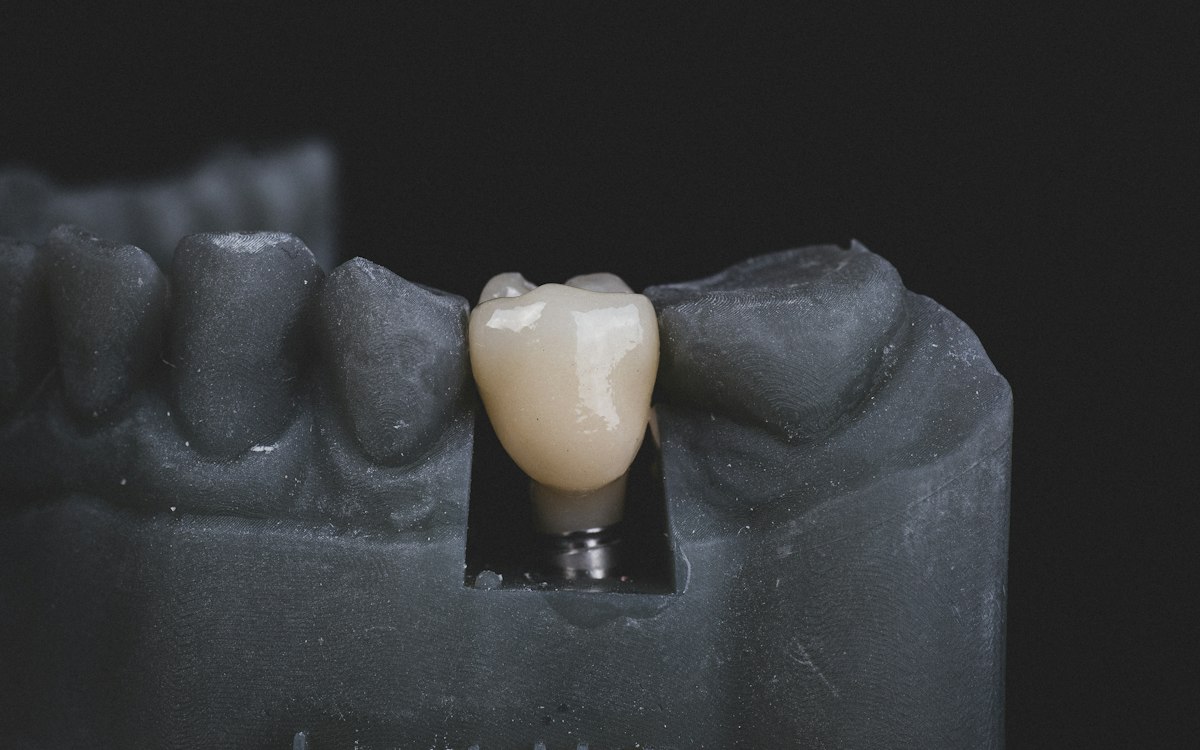 Coroană dentară pe un model de maxilar