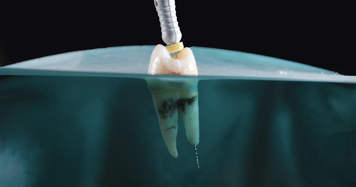 Implant dentar cu coroană, prezentat în secțiune