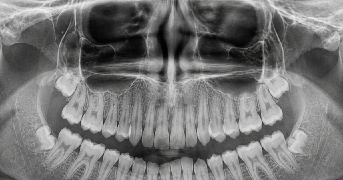 Radiografie panoramică dentară cu molarii de minte vizibili